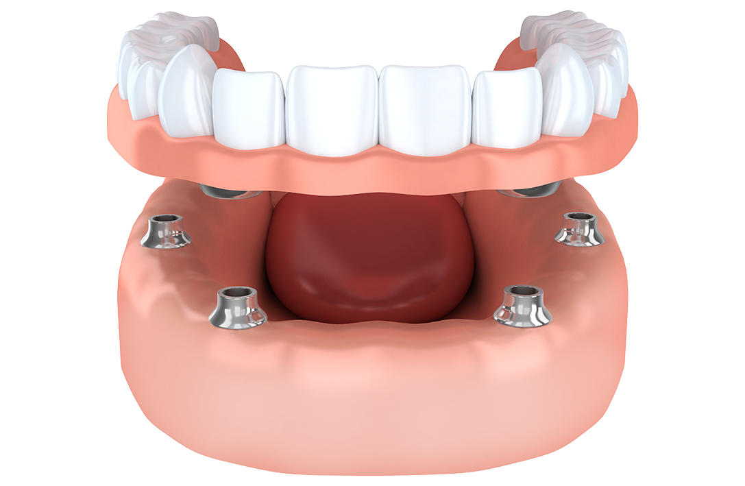 Surgical Dentistry Implant Denture