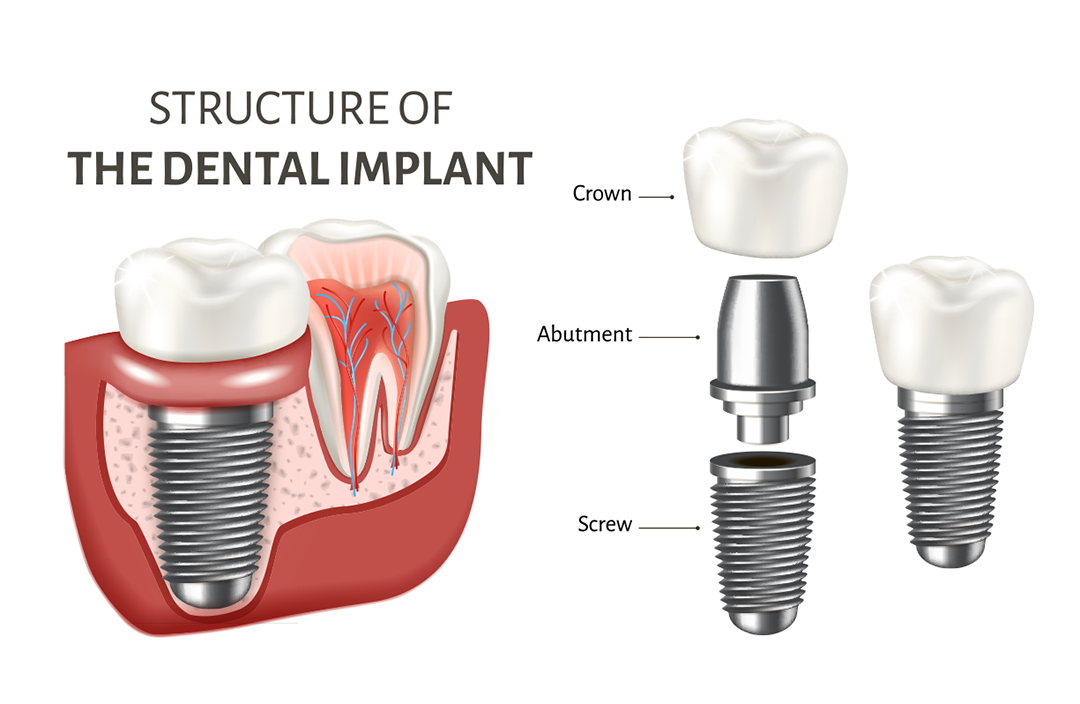 Surgical Dentistry Structure Implant