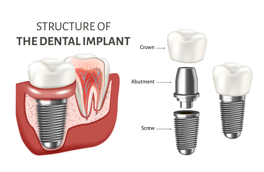 Surgical Dentistry Structure Implant 