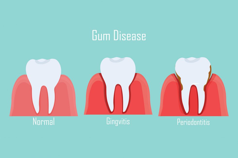 Why Do My Gums Bleed? Seven Causes And What Our General Dentistry ...